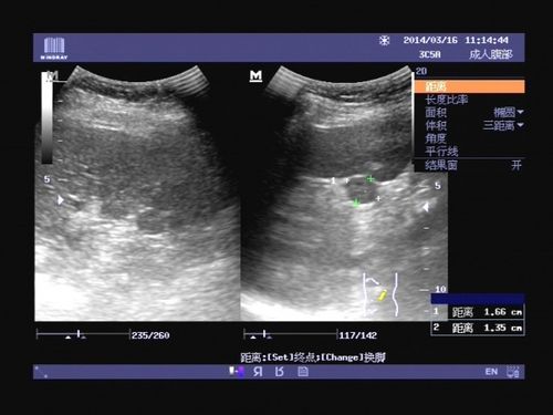 常规体检副脾? - 超声医学讨论版 - 爱爱医医学论坛 - 爱爱医医学网