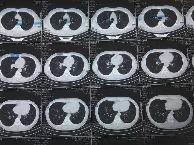 很多人认为既然拍胸片有辐射还发现不了肺部肿瘤,体检的时候做胸片