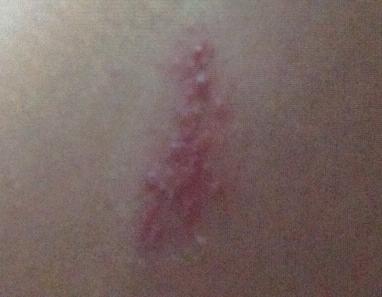 请问我腿上长的是带状疱疹吗