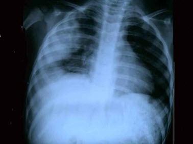 皮肤有猩红热皮疹,呼吸急促,鼻扇及三凹征明显,双肺散在中小湿啰音.