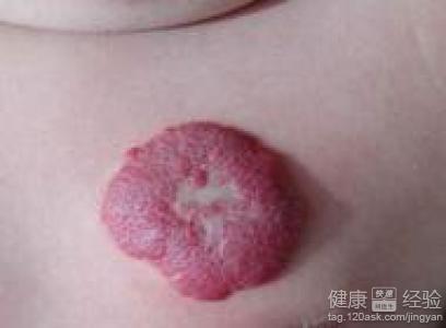 血管肉瘤的诊断检查血管肉瘤如何鉴别