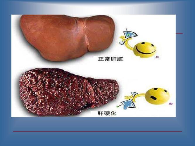 肝硬化失代偿期_-_特征与护理