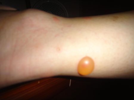 水泡 医生 皮肤病 脚脖和腿等起了个大,红痒,有的有水泡