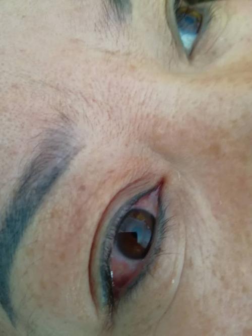 去医院说是干眼症,今天早上睡醒就这样了,胀痛,红血丝,只有一只眼睛