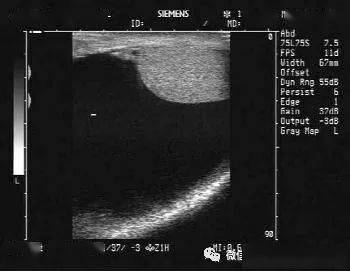 招飞体检常见异常:鞘膜积液_睾丸_阴囊_其他