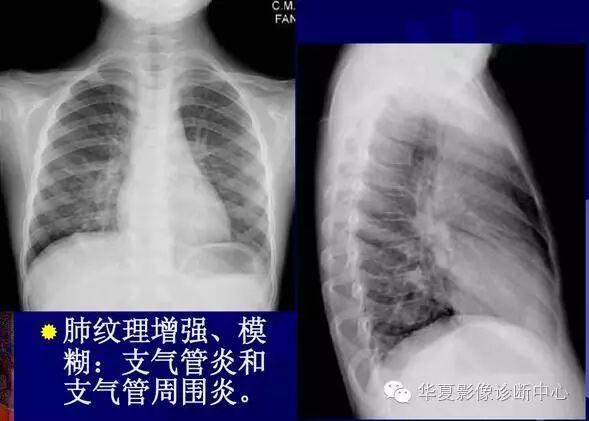 大叶性,小叶性,间质性肺炎你分清了吗?