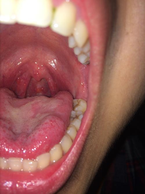 这个是不是咽喉癌?求好医生解答.万分感谢!