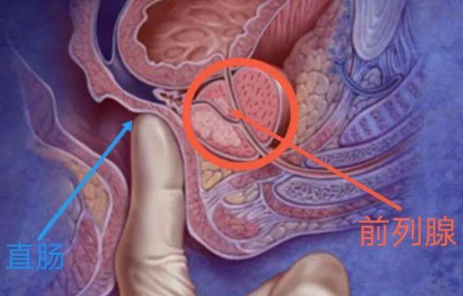 广州治疗前列腺炎医院啥是被憋出的前列腺炎