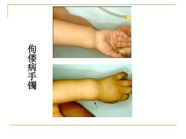 婴儿手足搐搦症,主要致病原因和佝偻病类似,血钙大多