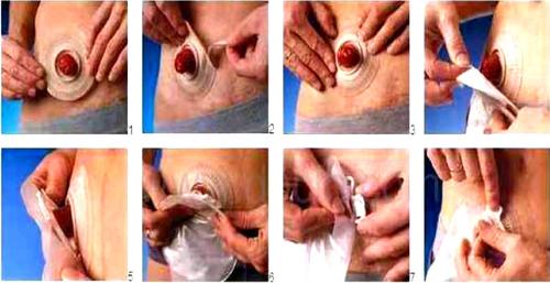 3.人工肛门袋每日清洁