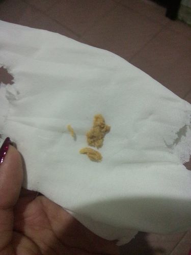 用完苦参凝胶排出这样的东西 这是什么