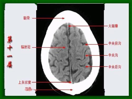 头颅ct 解剖图谱,人手一份