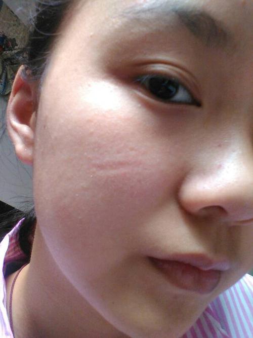 脸上这个凹陷的印要怎样才能消呢?