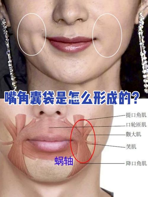 嘴角囊袋是怎么形成的?