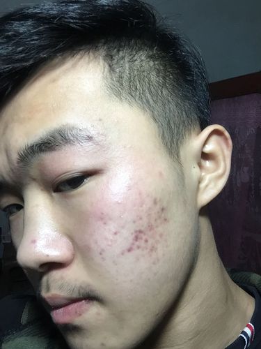 脸上很多红痘印用什么东西可以谈化呢,求之前有红痘印