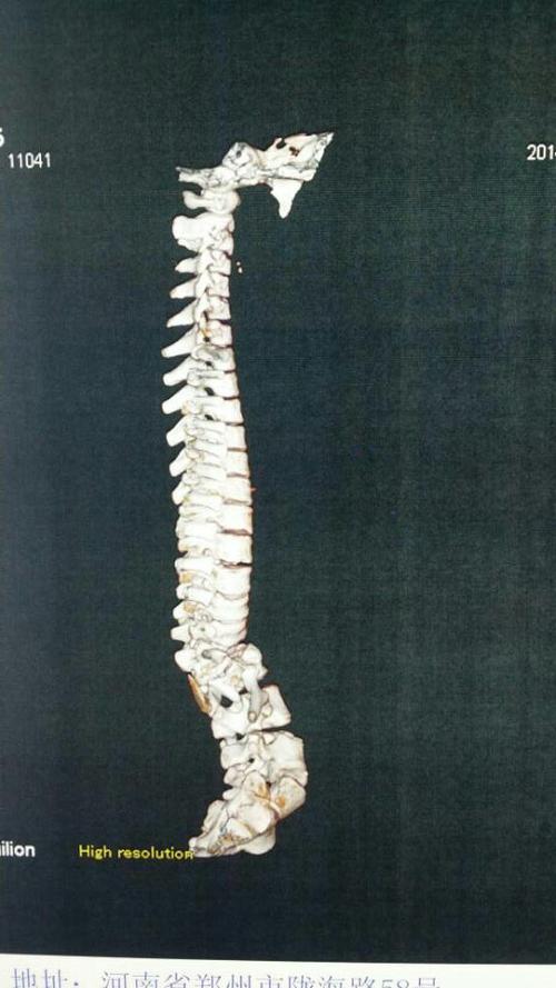 女/11/先天性脊柱侧后凸