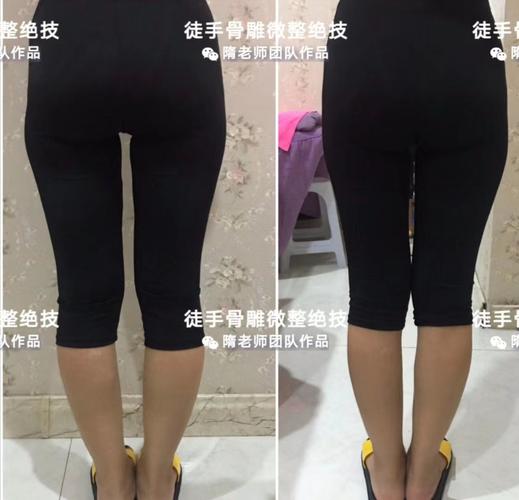 徒手身材骨雕抗衰管理为什么比市面普通骨盆闭合的效果好?
