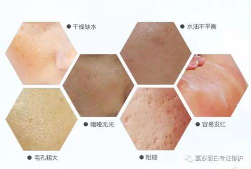 干燥缺水,水油不平衡,暗哑无光,毛孔粗大,粗糙,容易发红