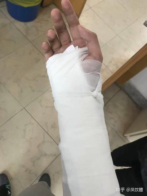 我就这样把右手三角骨弄断了