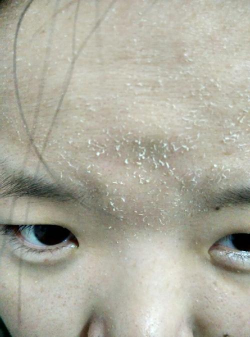 现在冬天,每一次洗完脸之后大概五分钟额头包括脸上会起很多干皮,额头