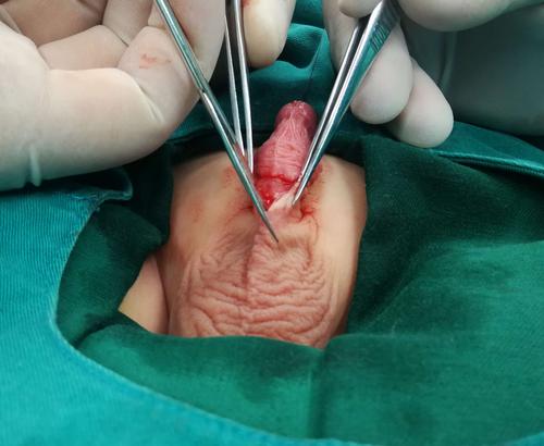 于两侧剪开包皮内板,消除狭窄环.