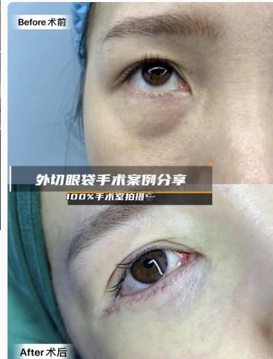 外切去眼袋前后对比