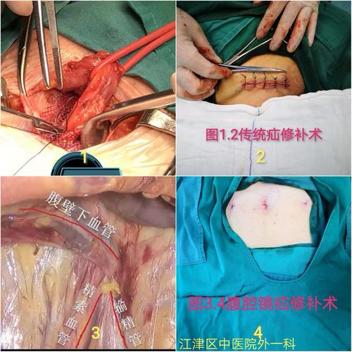 腹腔镜疝修补术--让疝患者"一日"出院成为可能!