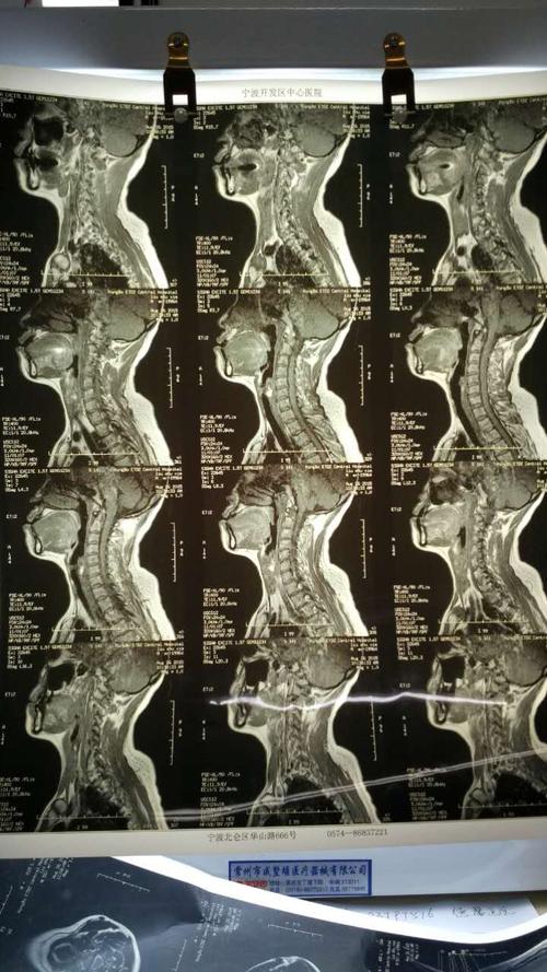 颈椎核磁片显示:颈4,5,6,7位颈椎间盘突出!