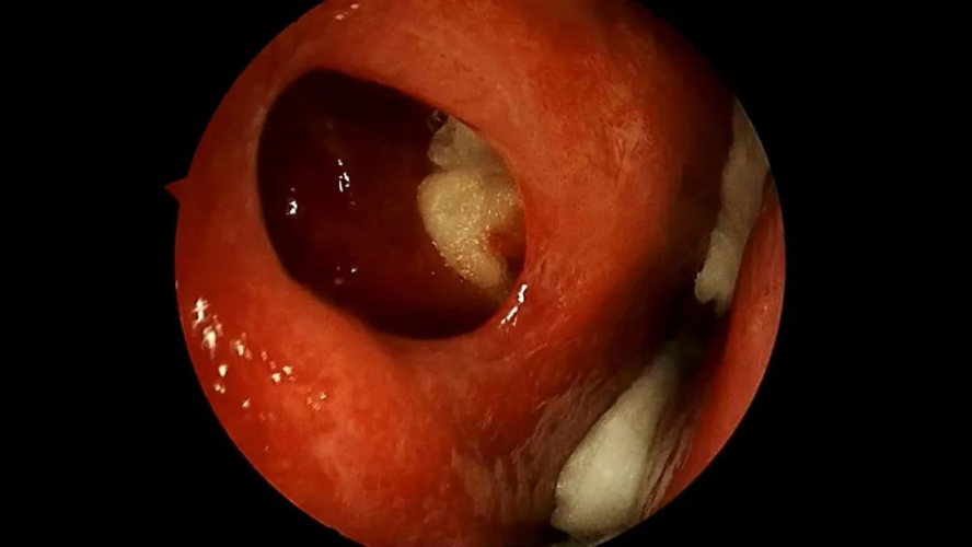 鼻内没了软骨,严重鼻中隔穿孔怎么补?