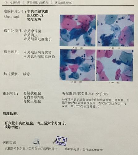 hpv18阳性,tct少量非典型细胞,现在很担心