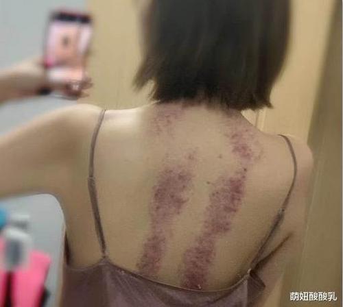 美女的后背有两处淤青,和我说是下雨不小心摔倒的,我