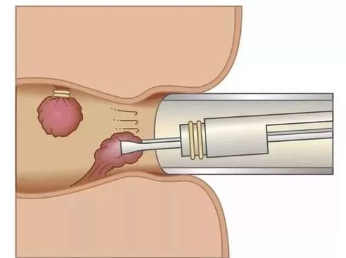 如果内痔长期脱出,还会出现疼痛和结硬感. 直肠癌作为肿瘤