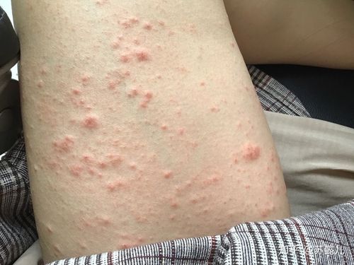 再也别见了,玫瑰糠疹!