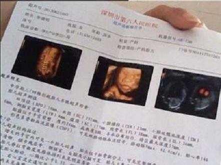 剖腹产会对女性子宫造成极大的创伤,如果过早怀孕,受精卵着床和胚胎