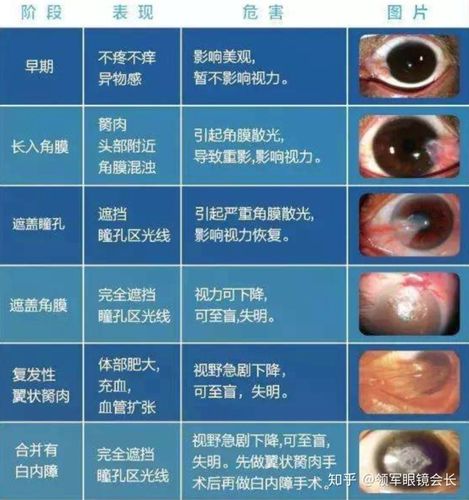 如胬肉浸润程度的进一步加深,深达深基质层,形成瘢痕