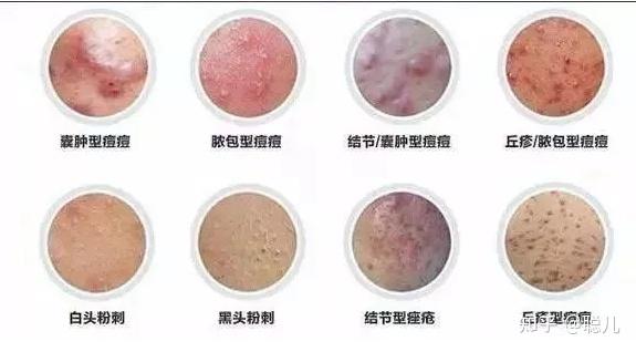 痘痘大概分为6类:白头,黑头,丘疹,脓包,囊肿,结节