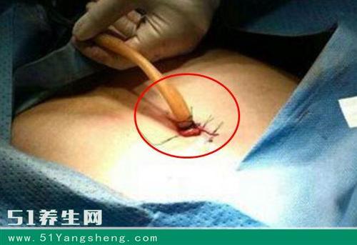 的避孕手术,但现在的医学已经能够实施输精管复通术和输卵管复通术