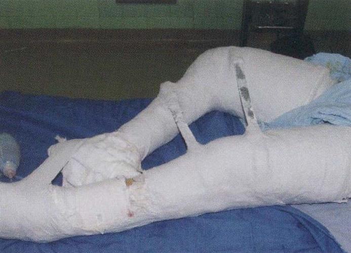 图8-1-3-3-8 皮片移植处及切口包扎完毕后,用石膏将双下肢固定于适当
