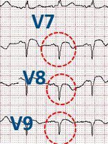图12:正后壁心肌梗死.