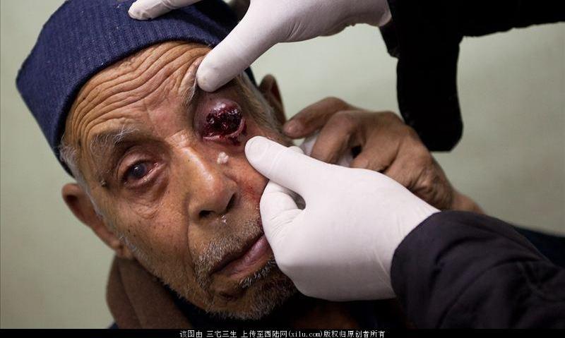 橡皮子弹也是子弹:击中人体后的伤口触目惊心!