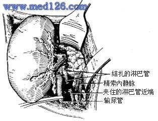 肾蒂淋巴管结扎,肾蒂淋巴管精索内(卵巢)静脉吻合术图片; 卵巢颗粒