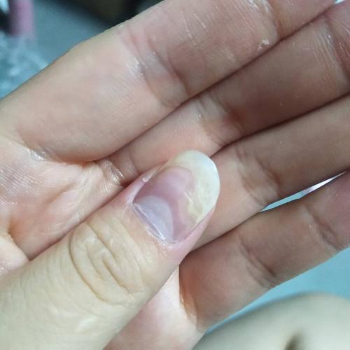 指甲空了,检查不是灰指甲,这是什么原因?