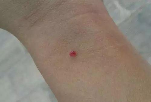 慢性肝病患友皮肤有红点,是蜘蛛痣吗?做下这动作就知道了