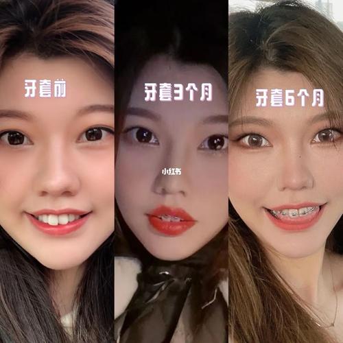 牙套半年前后对比_牙套_摄影_日记_整牙_牙套脸_清洁