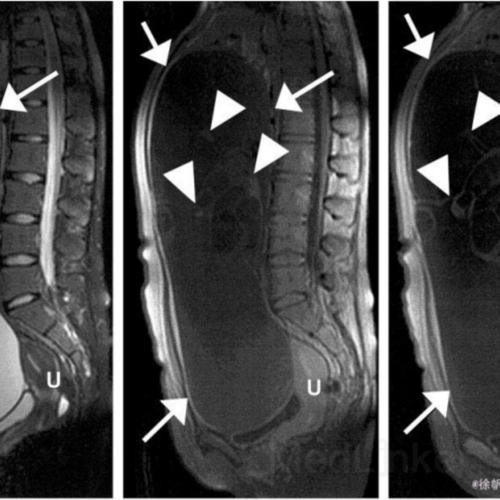 女性盆腔多房囊性巨大占位,考虑什么?