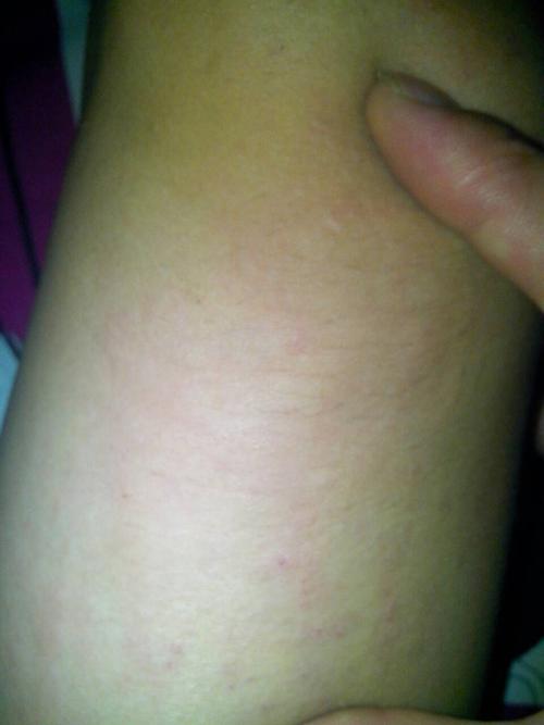 前两个月吃河虾出现全身都过敏.但是那以后就没