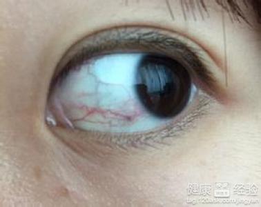 宝宝得角膜炎怎么办