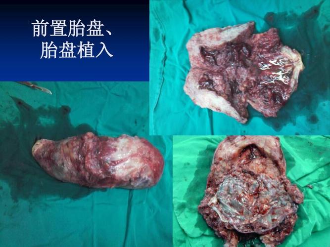 产科急症的辨识和处置之产前出血ppt