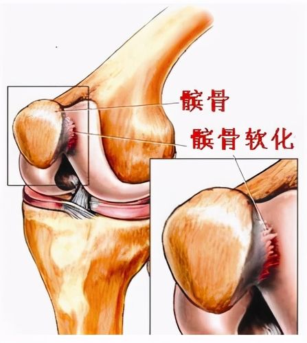 什么是髌骨软化症是缺钙引起的吗