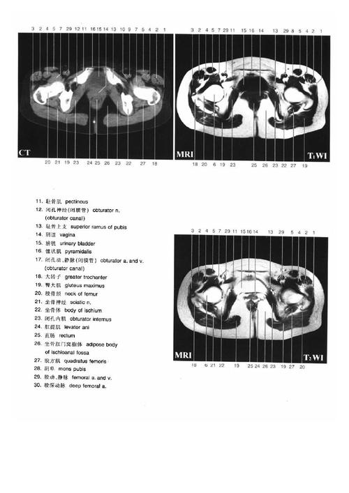女性盆腔断层解剖彩色图谱